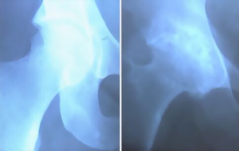 Belauneko artikulazioaren artrosiaren iskanbila