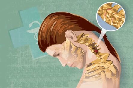 Osteokondrosiaren sintomak erreflexuak